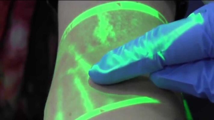 Croce Rossa Australiana, Vein Detector